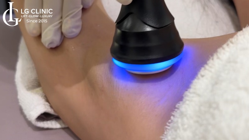 trị thâm nách bằng laser