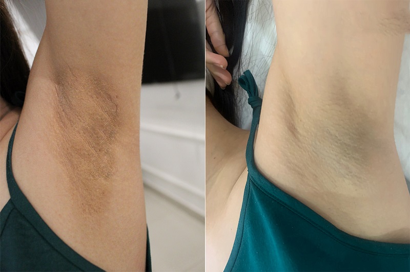 hiệu quả của trị thâm nách bằng laser