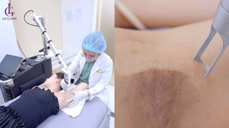 trị thâm nách bằng laser