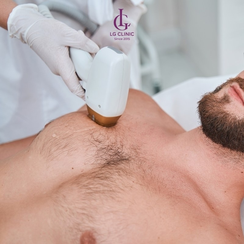 Triệt lông ngực bằng laser