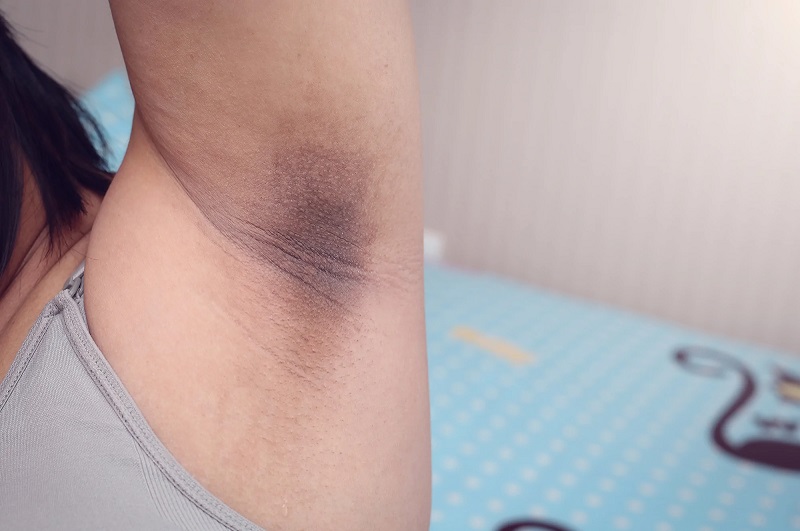 cách trị thâm nách ở tuổi dậy thì