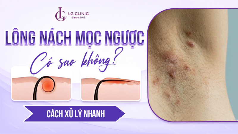 Lông nách mọc ngược