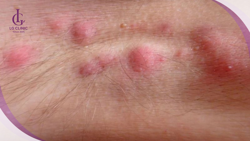 nách bị ngứa và thâm đen