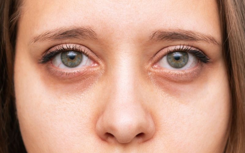 Thâm mắt do di truyền - Đi ngủ sớm có hết thâm mắt không