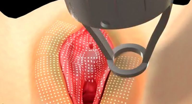 Trị thâm vùng kín bằng Laser
