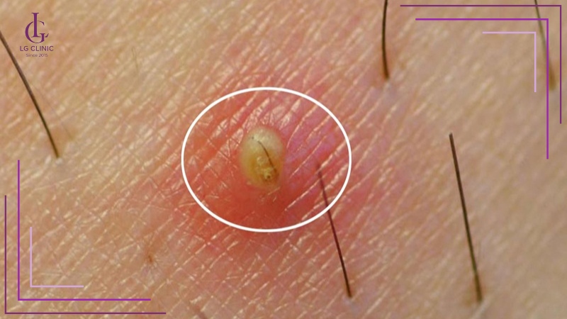 Lông mọc ngược ở vùng kín