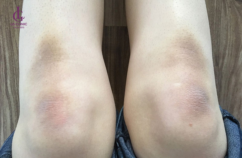 tại sao Đầu gối bị thâm