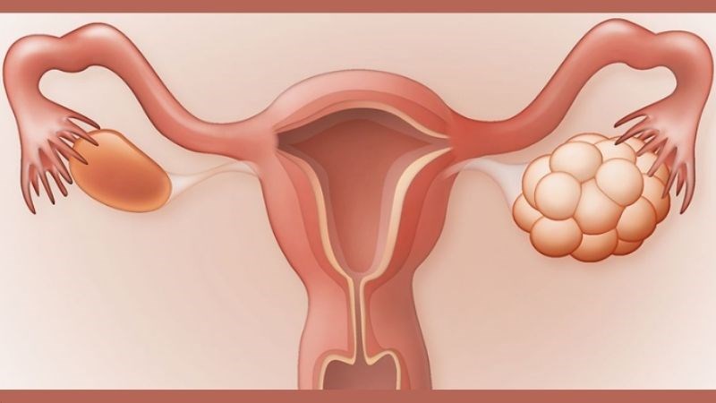 Hội chứng đa nang buồng trứng là nguyên nhân vùng kín thâm đen ở tuổi dậy thì