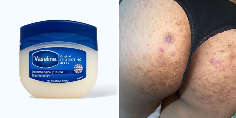 Cách trị thâm mông bằng Vaseline