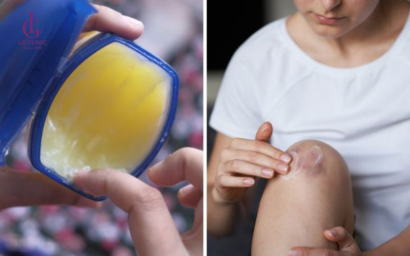 Vaseline nguyên chất - vaseline có trị thâm đầu gối không