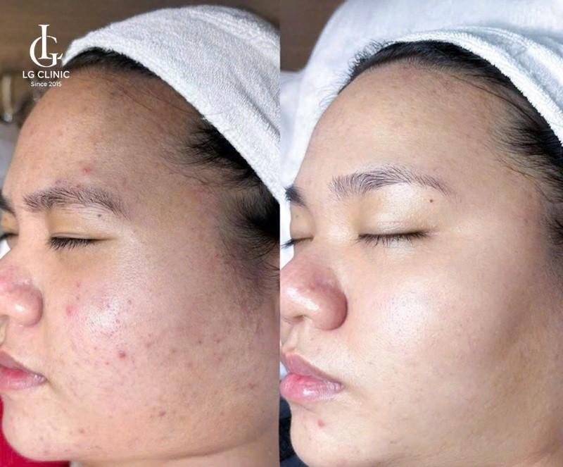 cách trị thâm đỏ sau mụn