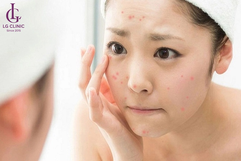 cách trị thâm đỏ sau mụn