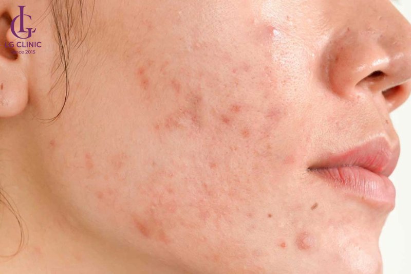 cách trị thâm đỏ sau mụn