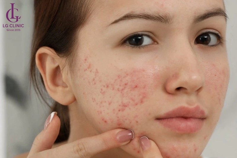 cách trị thâm đỏ sau mụn