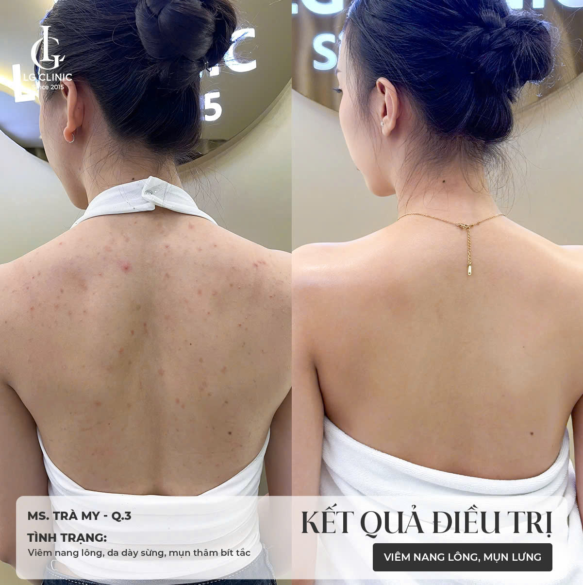 cách trị thâm mụn lưng