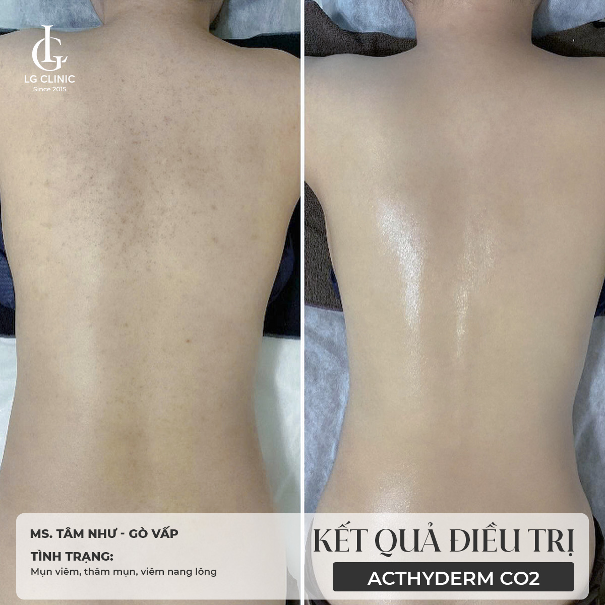 cách trị thâm mụn lưng