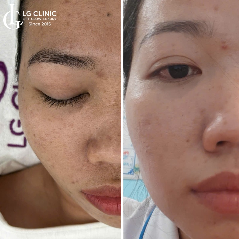 Lăn kim trị thâm mụn có tốt không