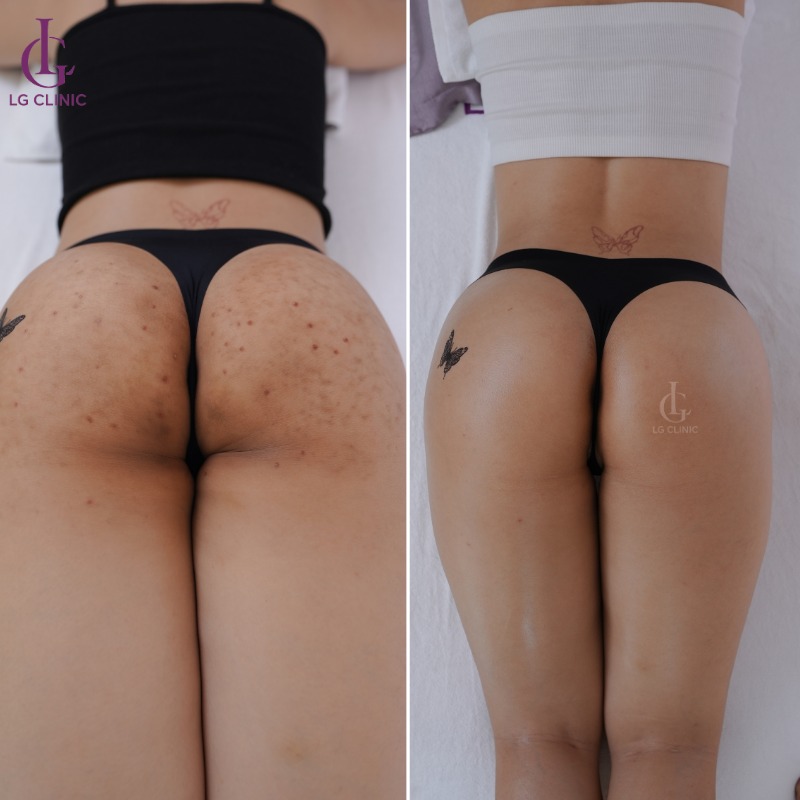 spa trị thâm mông