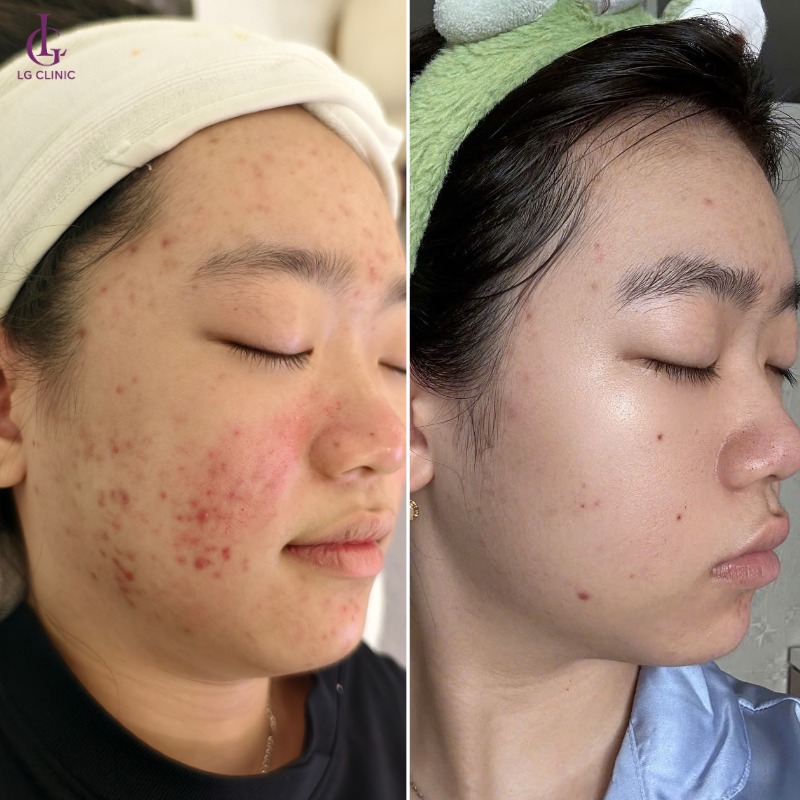 tại sao thâm mụn không hết