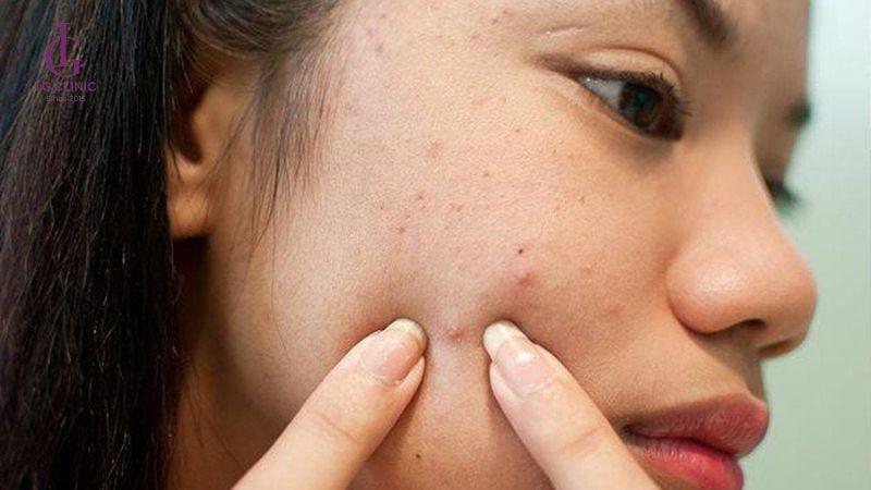 Tại sao thâm mụn không hết