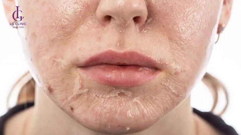 Tại sao thâm mụn không hết