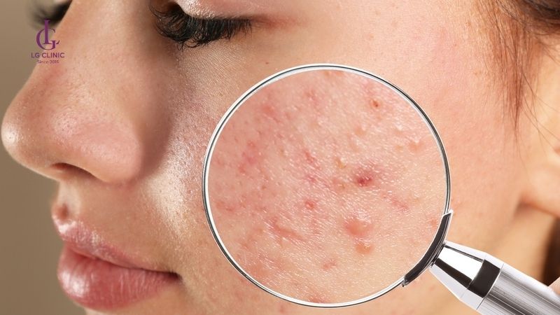 Thâm mụn bao lâu thì hết