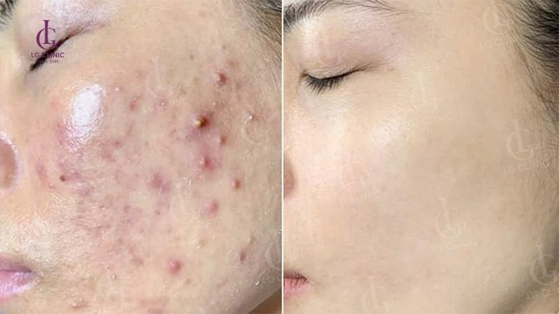 Thâm mụn bao lâu thì hết