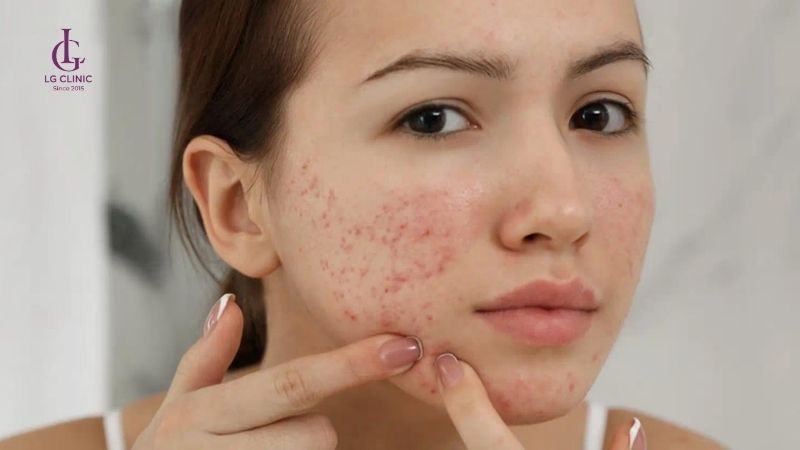 Thâm mụn bao lâu thì hết