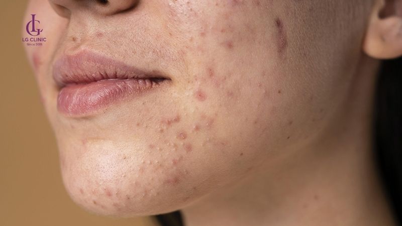 Thâm mụn bao lâu thì hết