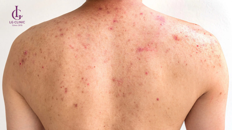cách trị thâm mụn lưng