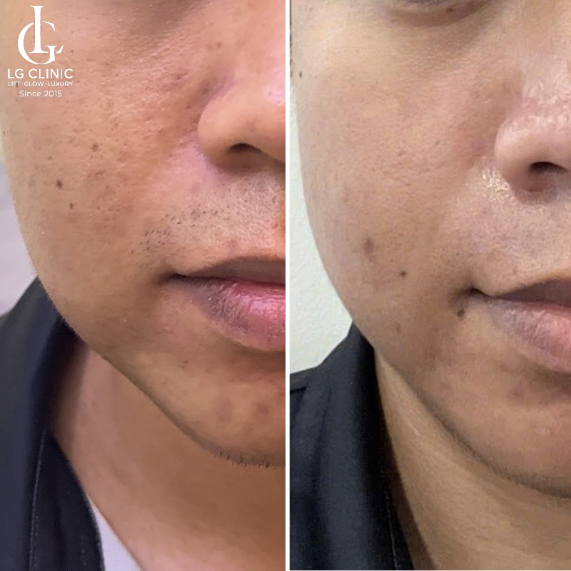 dầu gấc trị thâm mụn