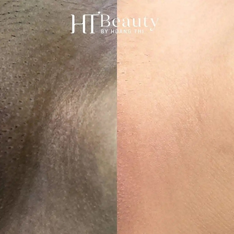 Hình ảnh liệu trình trị thâm bẹn của khách hàng tại HT Beauty 