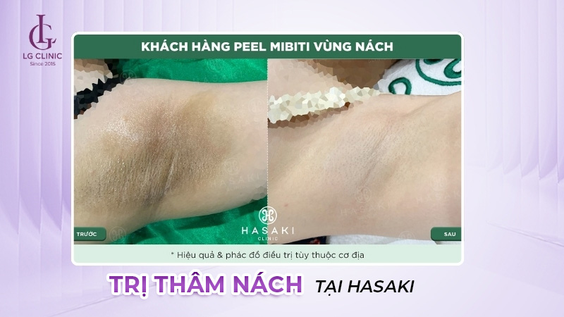 Xoá thâm nách tại Hasaki Clinic