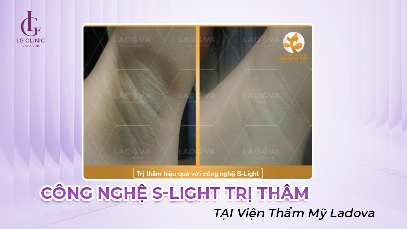 Liệu trình trị thâm nách tại Viện thẩm mỹ Ladova