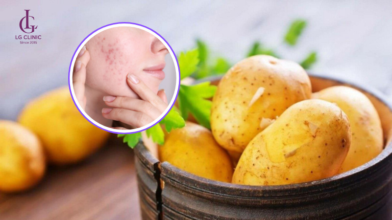 mặt nạ khoai tây trị thâm mụn