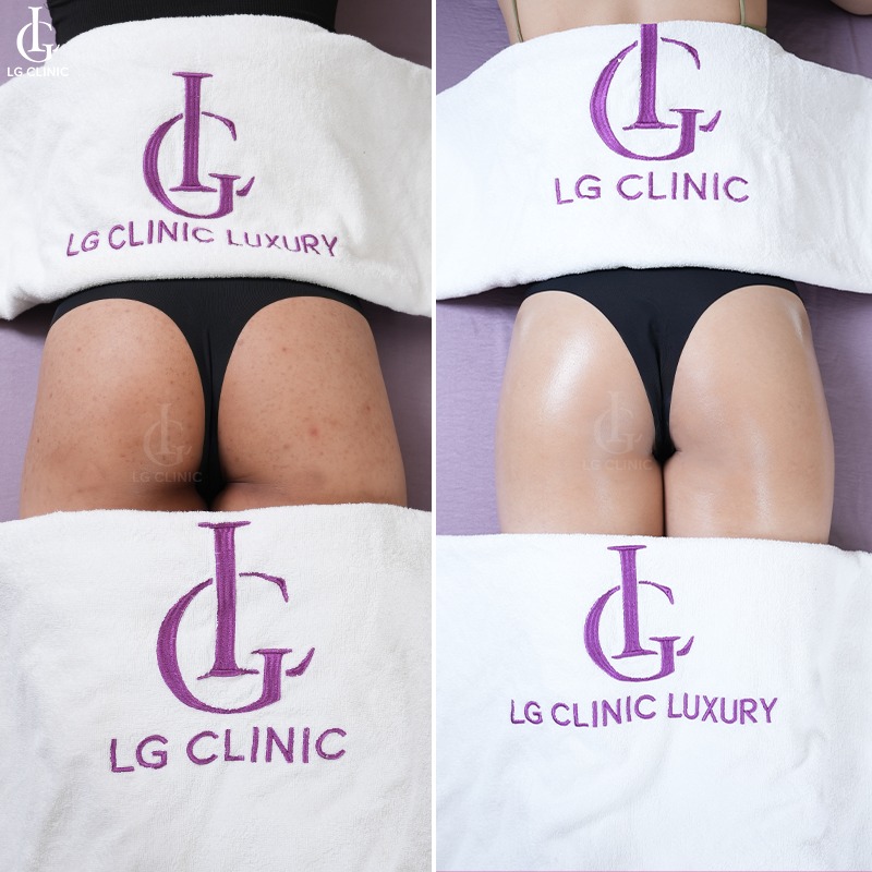 spa trị thâm quận Tân Bình