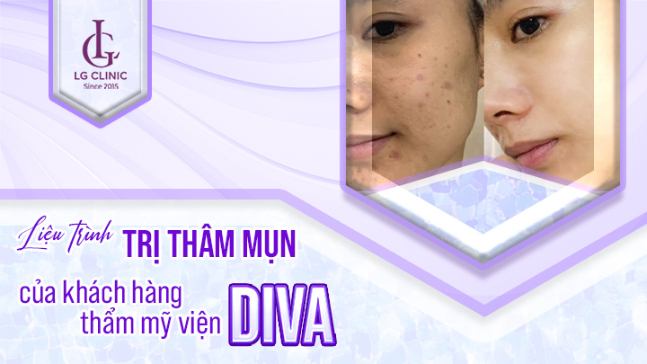 Khách hàng trị thâm tại thẩm mỹ viện Diva