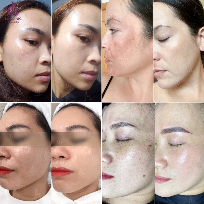 Hình ảnh các khách hàng đã trị thâm sạm tại LG Clinic 