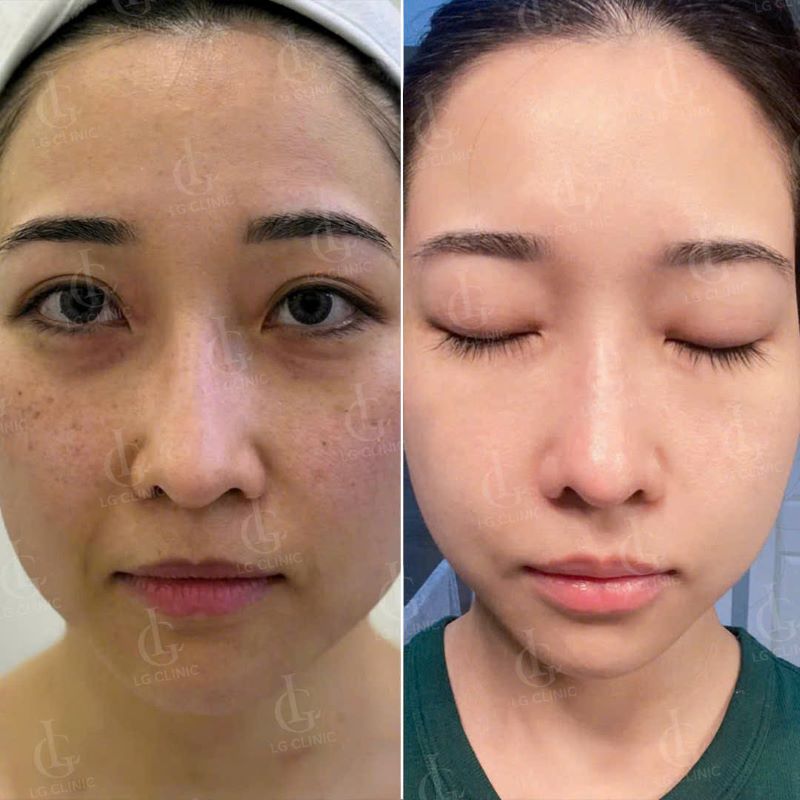 Trị thâm sạm, tàn nhang tại LG Clinic