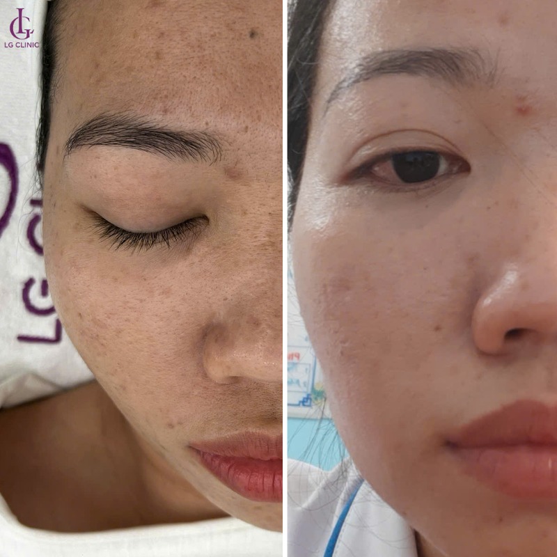 cách trị thâm mụn bằng vitamin e