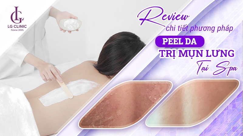 Peel mụn lưng có tốt không