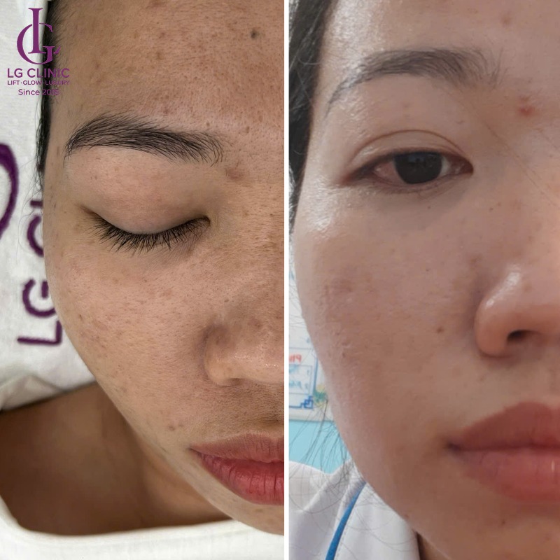trị mụn thâm bằng nha đam