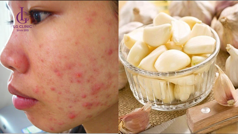 Cách trị thâm mụn bằng tỏi