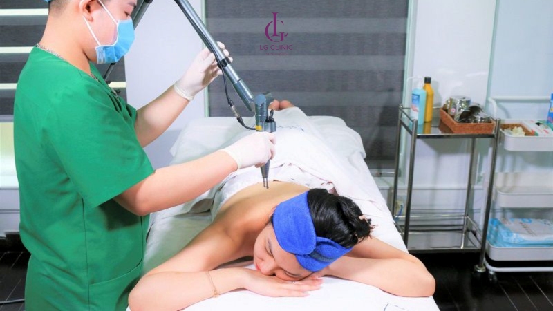Trị thâm mụn lưng bằng laser tại spa