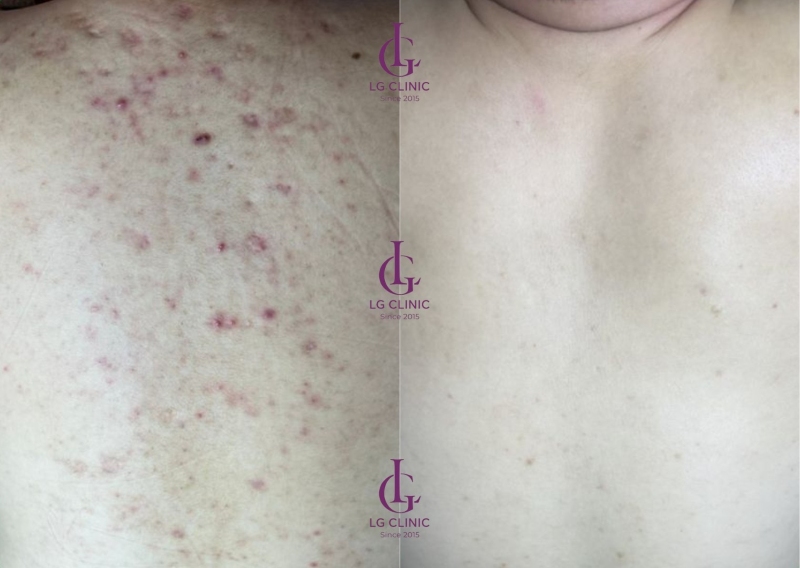 Trị thâm mụn lưng bằng laser