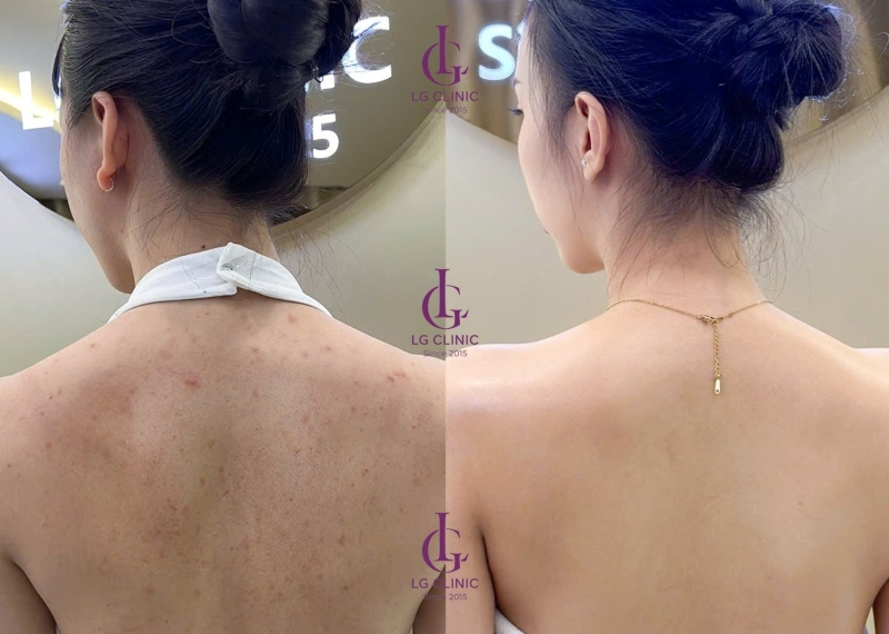 Trị thâm mụn lưng bằng laser