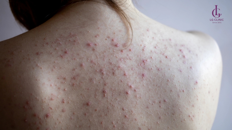 Trị thâm mụn lưng bằng laser giá bao nhiêu