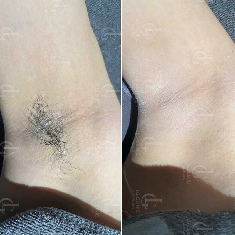 triệt lông nách