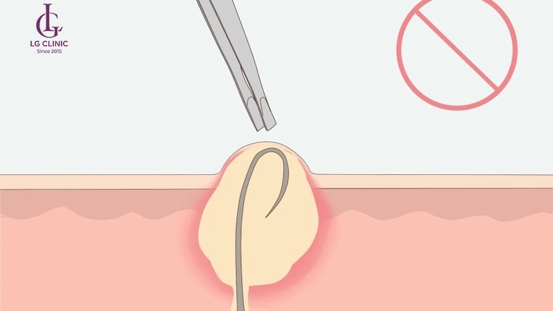 Triệt lông sai kỹ thuật dễ gây lông mọc ngược và tổn thương da
