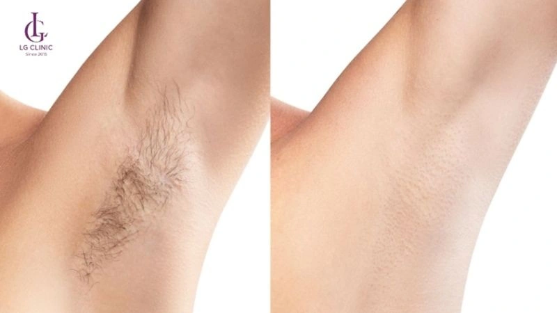 Triệt lông IPL có tốt không? Công nghệ triệt lông an toàn, hiệu quả cao